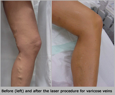 Fast, painless treatment of varicose veins, spider veins, and other vein diseases at St. Louis Laser & Vein Center, Chesterfield, Missouri-west St. Louis County. 