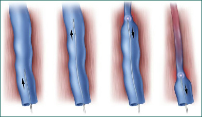Endovenous laser therapy is an outpatient procedure for vericose veins provided by the Saint Louis Vein Center, Chesterfield, Missouri (West St. Louis County, MO).
